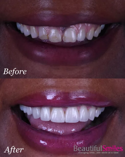 Smile transformation