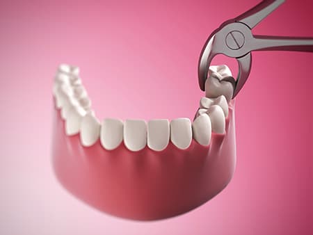 What You Need To Know About Having A Tooth Extracted